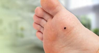 Astrological Meaning of Moles on the Bottom of the Feet